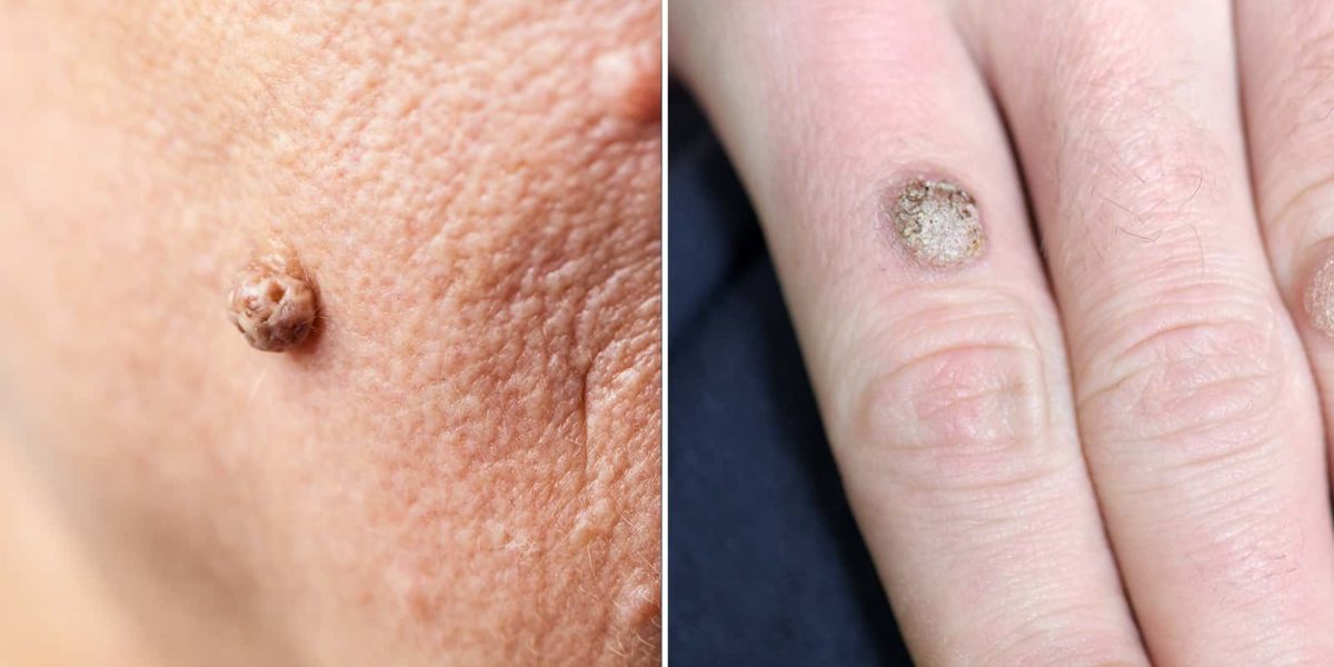 How to Remove Warts and Skin Tags Permanently Stuff! Lovely!