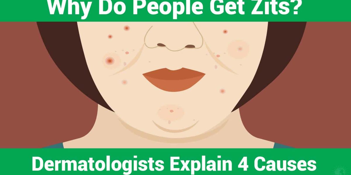 Why Do People Get Zits? Dermatologists Explain 4 Causes Stuff! Lovely!