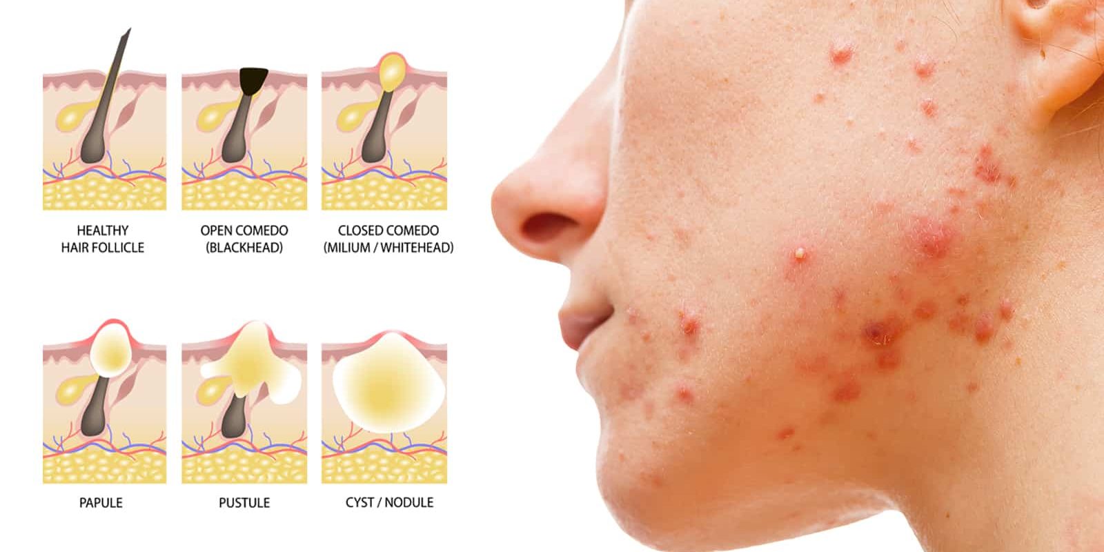 15 ScienceProven Habits That Improve AcneProne Skin Stuff! Lovely!